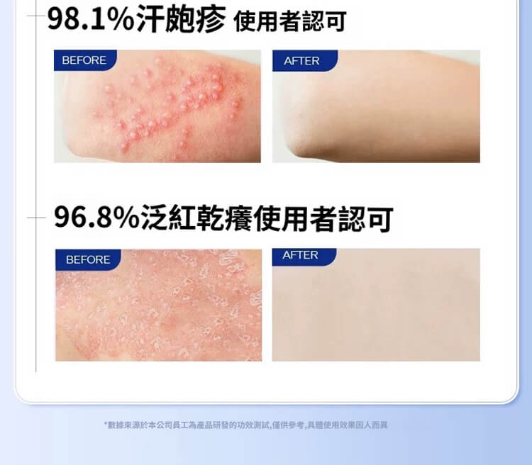 舒克炎抑菌乳膏